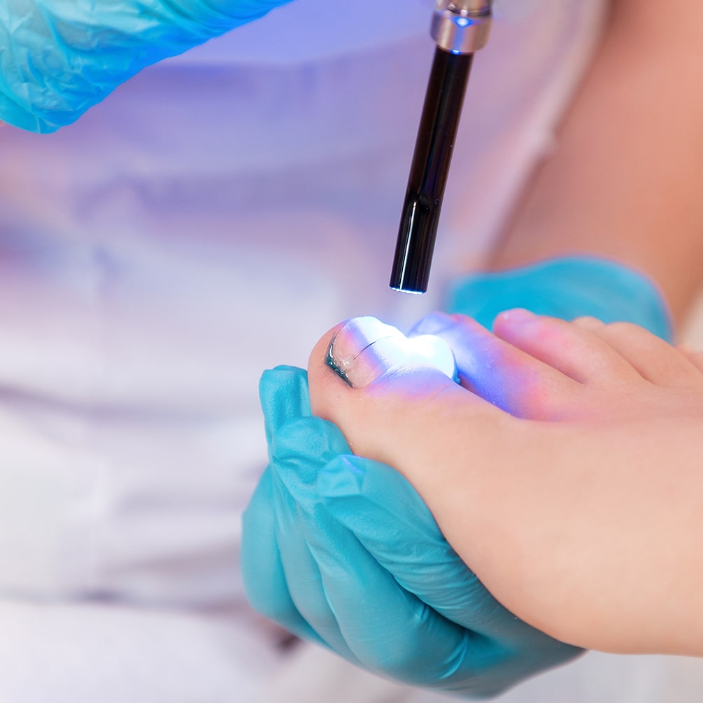 Laser for Nail Fungus min