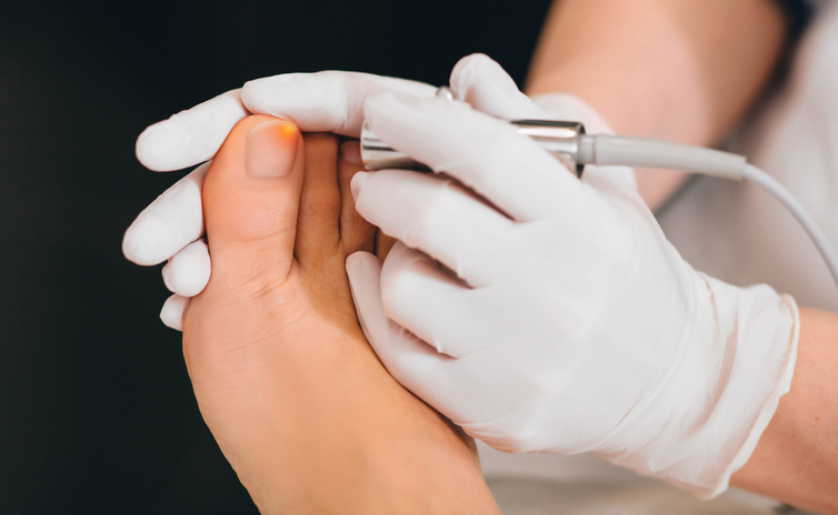 laser treatment on toenail, fungal infection on the toenails