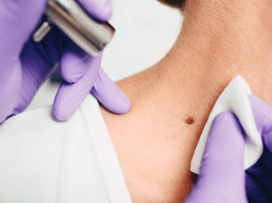 Mole Removal