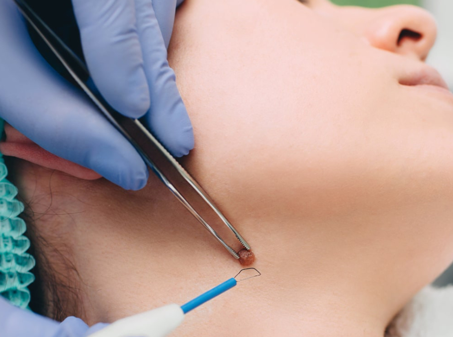 Mole removal