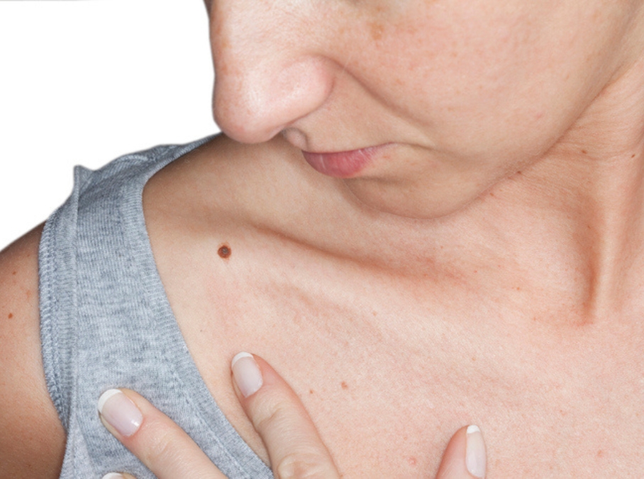 Skin Tag Removal
