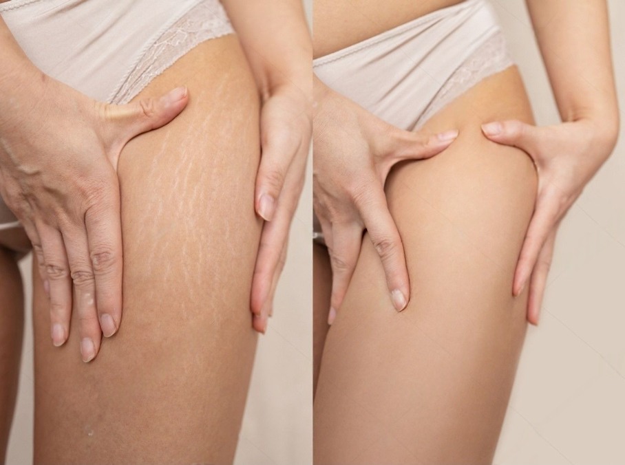 stock photo image compare before and after woman legs with stretch marks removal treatment real people skin 2266034319 (1)