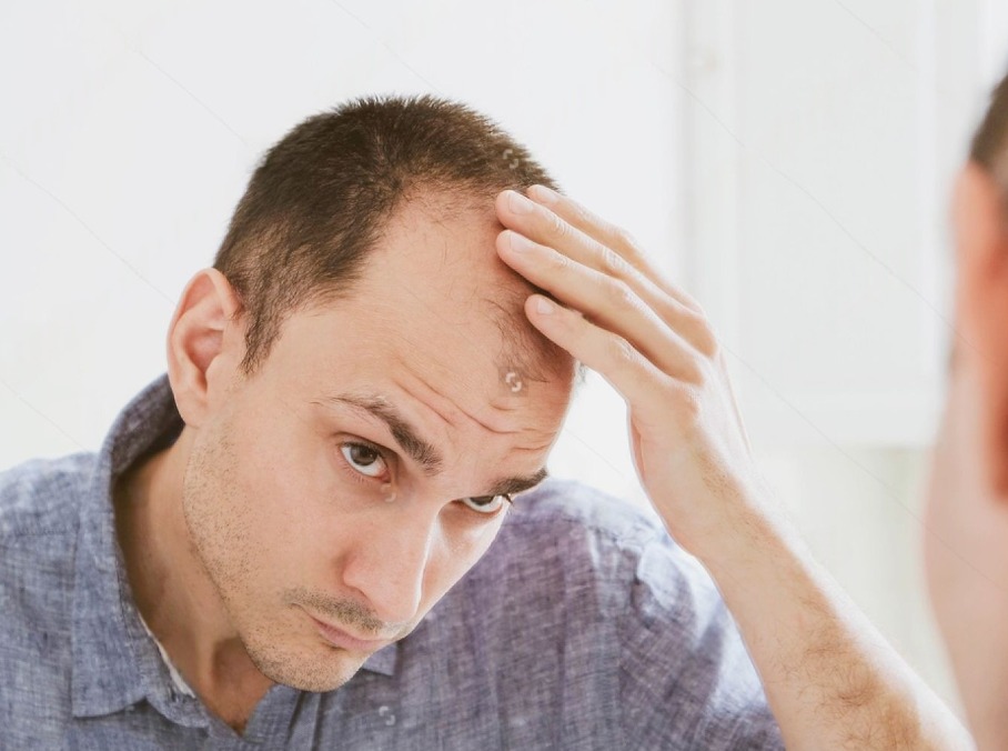 stock photo male pattern hair loss problem concept young caucasian man looking at mirror worried about balding 1819418921 (1)